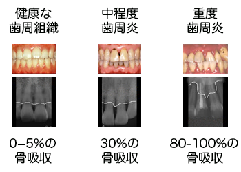 エックス線検査で評価される歯槽骨の喪失量