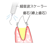 大まかな歯石除去
