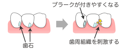 歯石の問題