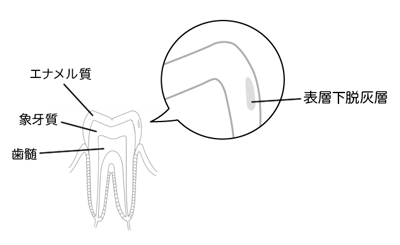 初期むし歯