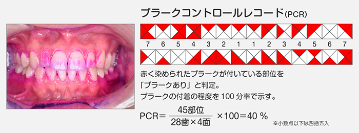 染色液によるプラーク付着率の検査