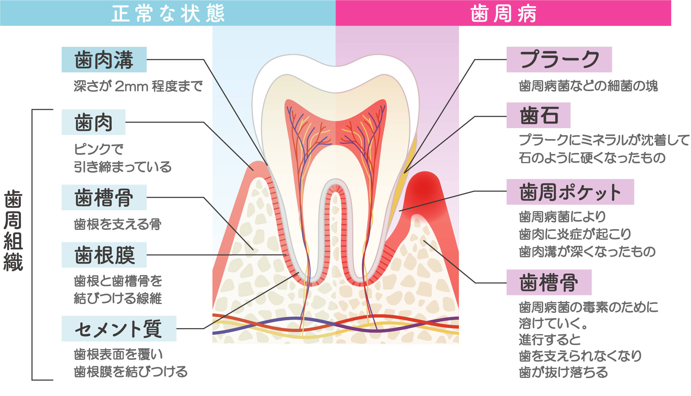 歯周病の症状